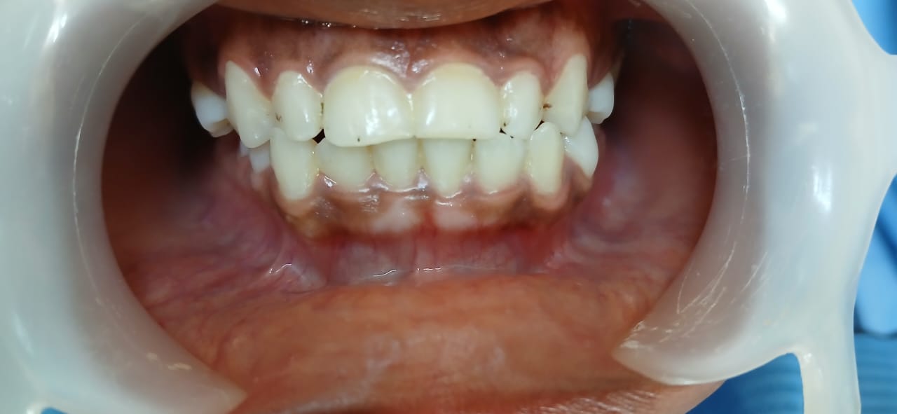 Depois do tratamento — Caso 2