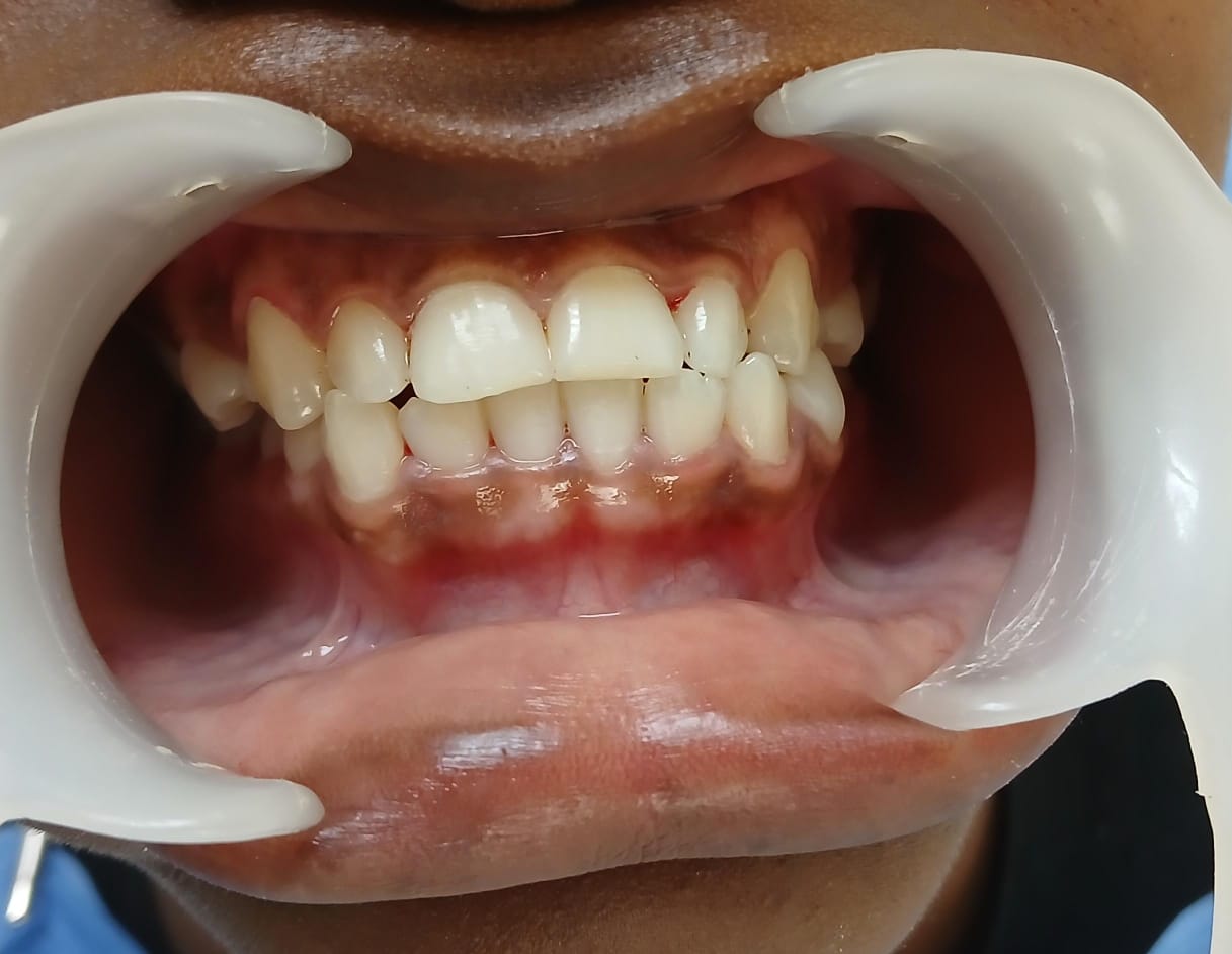 Antes do tratamento — Caso 2