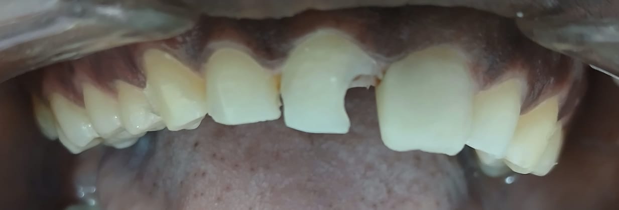 Depois do tratamento — Caso 1